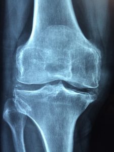 knogle der vises på røntgen