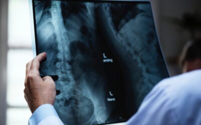 røntgen af ryg med diskusprolaps